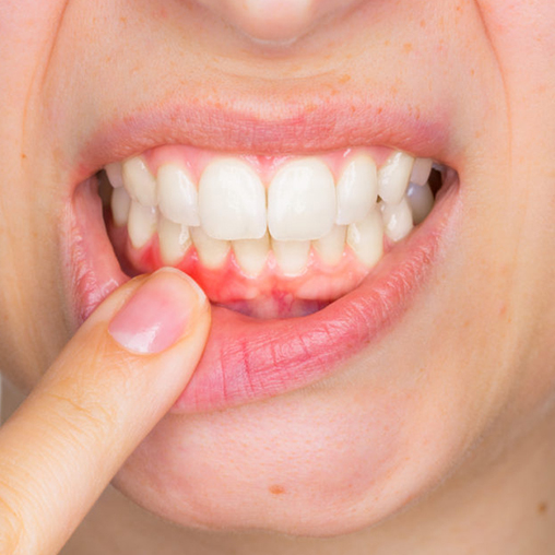Why do my gums bleed?
